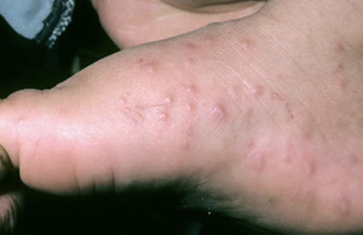 Ayakta kırmızı lekeler neden olur hastalık habercisi mi?