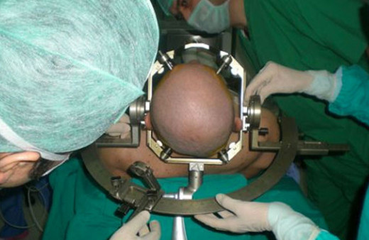 Beyin ameliyatlarının süresi kısalacak!