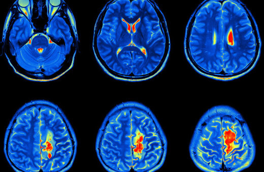 Beyin tümörü tedavi edilebilir mi? Beyin tümörü ve tedavisi... 
