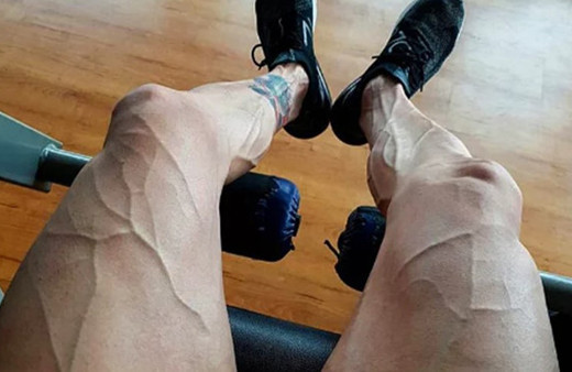 Damarlarınız diğer insanlara çok belirginse dikkat