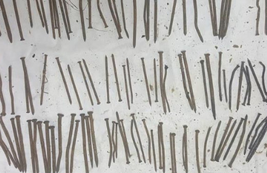 Midesinden çıkan 120 adet çivi şoke etti