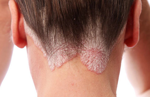 Sedef hastalığı kimlerde görülür? Ailenizde varsa dikkat!