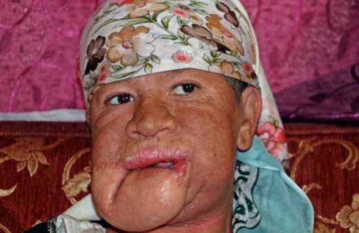 Çenesinde çıkan sivilce hayatını kabusa çevirdi!