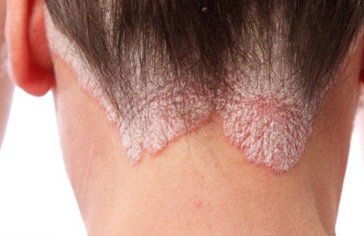 Sedef hastalığı nedir tedavisi var mıdır?