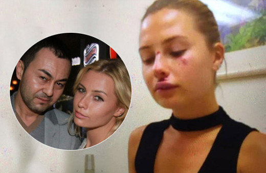 Serdar Ortaç'ın yalanı ifşa oldu! Chloe Loughnan dayak yemiş