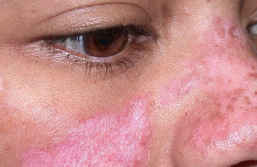 Lupus hastalığı nedir SLE ölümcül müdür belirtisi ve tedavisi