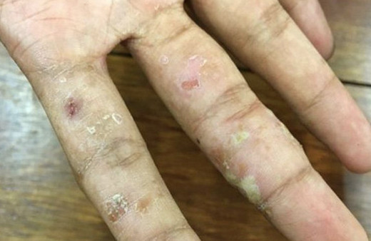 Lupus hastalığı bulaşıcı mı SLE hasta yorumları neler söylediler
