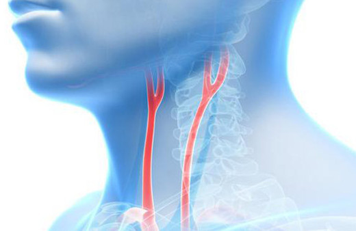 Şah damar tıkanıklığı nedir neden olur? Unutkanlık en sık belirtisi... 