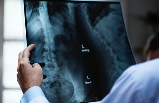 Kırılgan kemik yapısı kan kanseri habercisi olabilir!