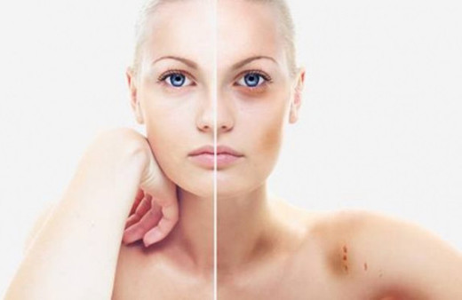 Gözaltı morluklarının nedenleri ve tedavisi yöntemleri...