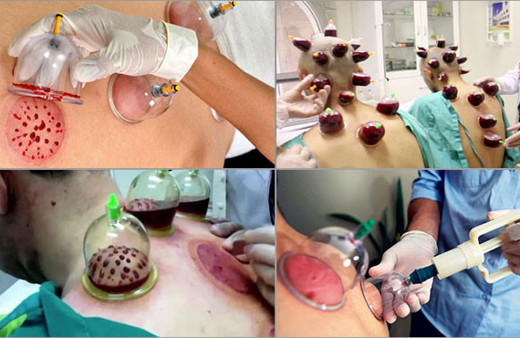 Hacamat günleri hangisi hangi günlerde yaptırılmaz?