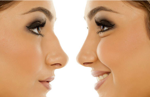 Burun estetiği Rinoplasti ameliyatı nasıl oluyor? 
