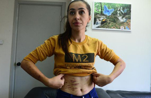 Lazer epilasyon faciası ! Genç kızı resmen yaktılar