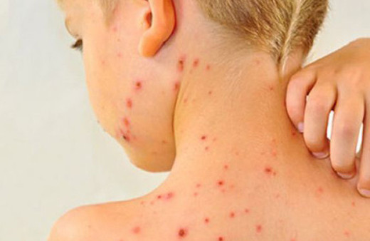 Kızamık salgını 12 canı aldı