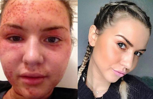 İnanamayacaksınız ama ikisi de aynı kadın egzemadan nasıl kurtuldu?