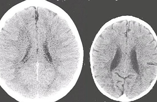 İlgi görmeyen çocuğun beyni yaşıtlarına göre daha küçük Bilim adamları açıkladı