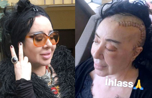 Nur Yerlitaş peruğu çıkarınca son hali ortaya çıktı işte o görüntüsü