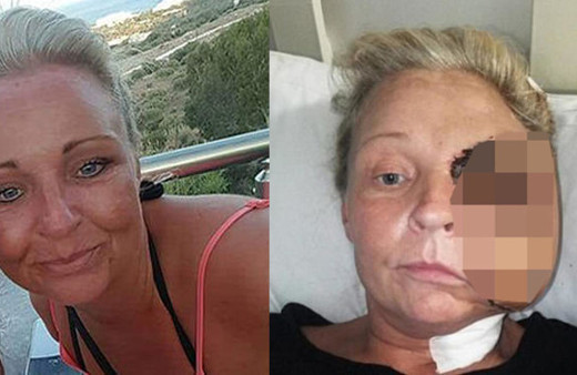 Bir günde hayatı karardı! Et yiyen bakteri bu hale getirdi