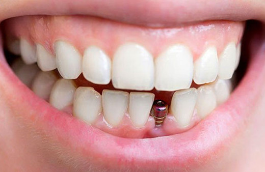 Diş hekimi Engin Taviloğlu: "Diş fırçalamak yerine implant yaptırıyorlar!"