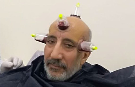 Abdurrahman Dilipak kendine ne yapmış öyle göz için hacamat yapılır mı?