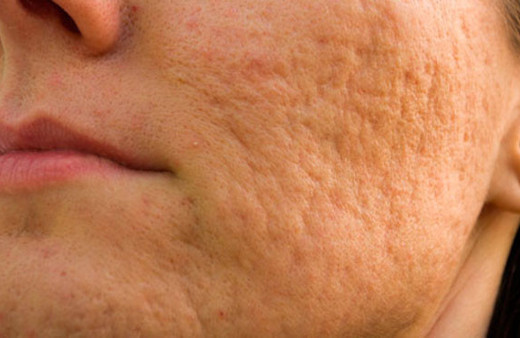 Sivilce lekelerinden kurtulmak için bu doğal yöntemleri deneyin