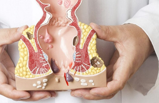 Hemoroid nasıl geçer acı yemek basuru azrıyor mu? 