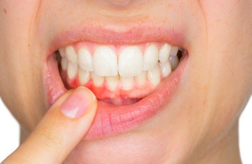 Diş eti problemlerini hafife almayın! Diş kaybına kadar gidiyor