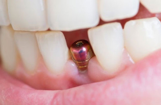 İmplant yaptırırken nelere dikkat edilmelidir?