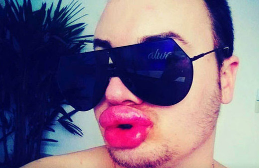 Dudak dolgusu faciası 27 bin lira verdi sonucu şoke etti