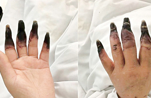 Küçük yara deyip önemsemedi parmaklarının kesilmesi ile karşı karşıya kaldı