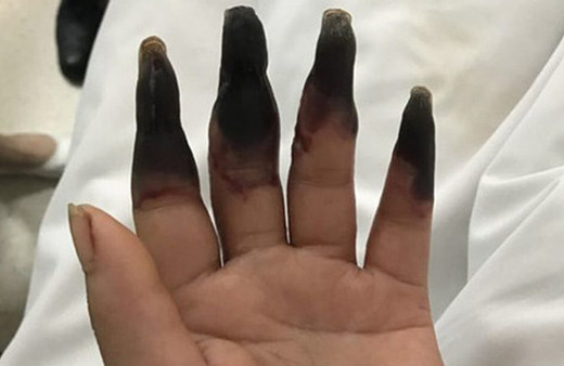 Parmakları biranda karardı sebebini duyunca şoke olacaksınız