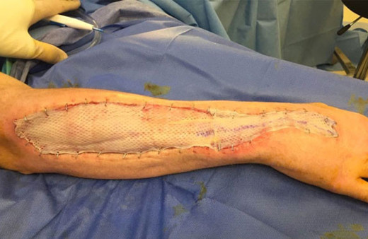 Et yiyen bakteri kolunu yiyor 1 haftada kolunun yarısı gitti