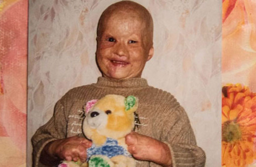 Babası yanan odun fırınının içine attı kardeşi öldü kendisi işte bu halde