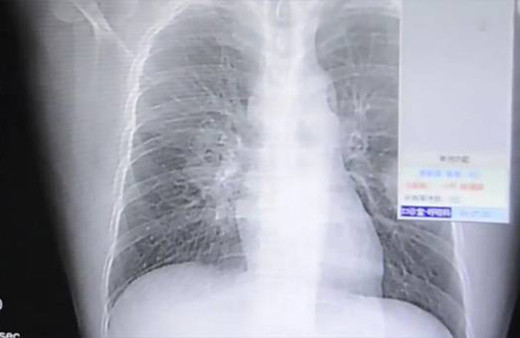 Çorap koklama bağımlısı adamın ciğerleri mantar bağladı