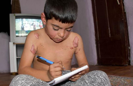 Vücudundaki yanıklardan utanan minik Siraç okulu bıraktı yardım bekliyor