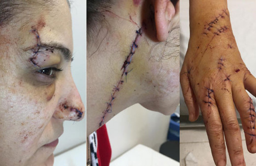 Platonik aşk dehşeti genç kadına 80 dikiş atıldı