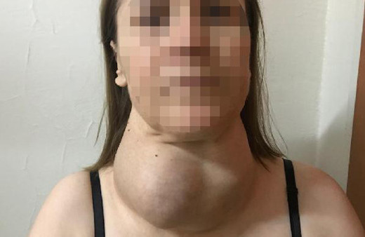 Ameliyattan korktu dev guatr ile 30 yıl yaşadı