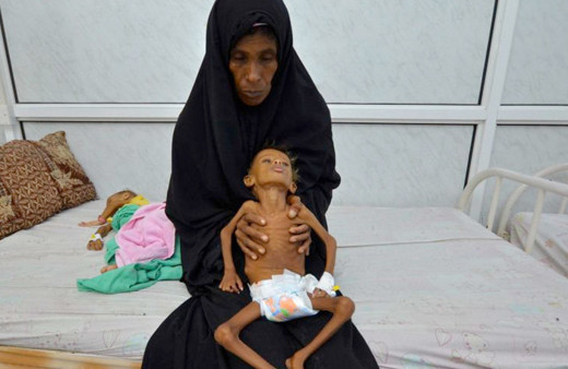 Yemen açlıktan ölüyor çocuklar bir deri bir kemik son duruma bakın