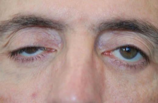 Göz kapağı düşüklüğü kimlerde daha çok görülür tehlikesi var mıdır?