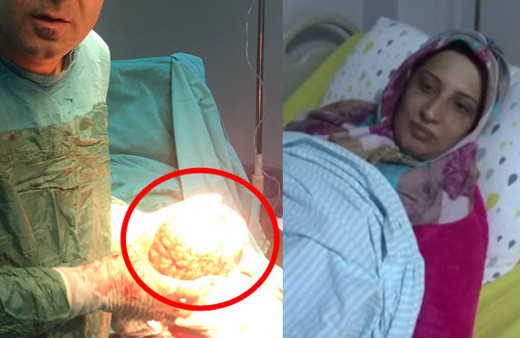 8 aylık hamile sanılan kadının karnından çıkan şey şok etti