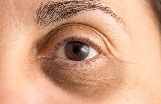 Göz altı morlukları tehlikeli midir nasıl giderilir?