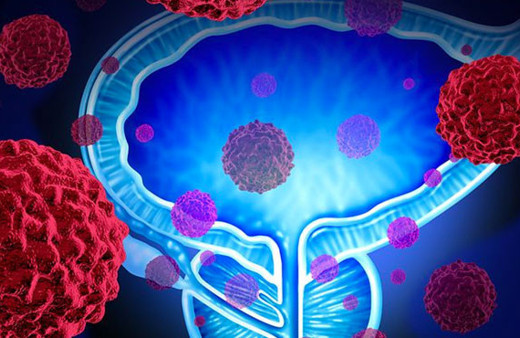 Bor bileşikleri 'prostat tedavisi'nde kullanılabilir mi?