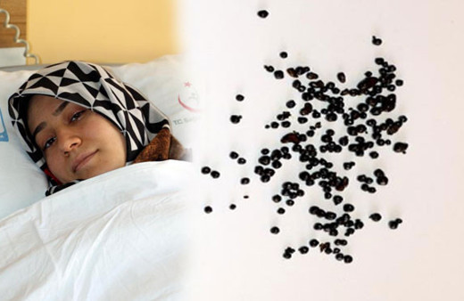 Karnından tam 200 adet taş çıktı başhekim şaşkına döndü