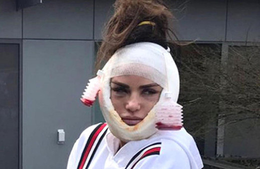 Katie Price yüz germe ameliyatını yayınladı!
