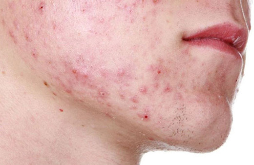 Akne probleminde bol su içmek faydalı olur mu?