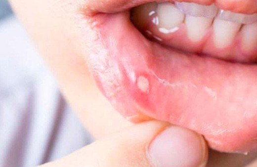 Aft neden oluşur tedavisi için yapılması gerekenler