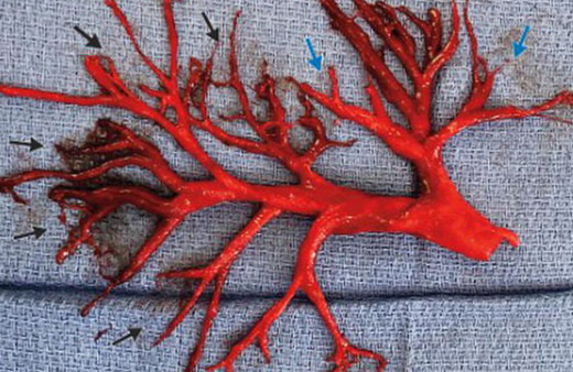 Akıl almaz ölüm! Öksürürken ciğerini kustu