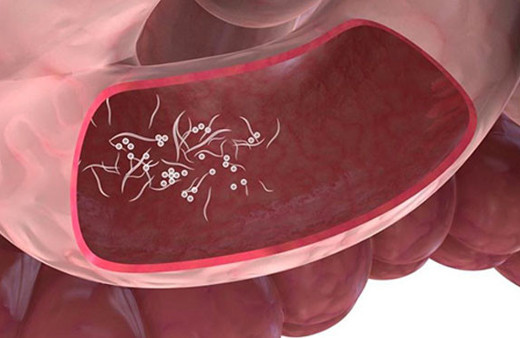 Açık yaralar 'Kurt Tedavisi' yöntemi ile kapatılabiliyor