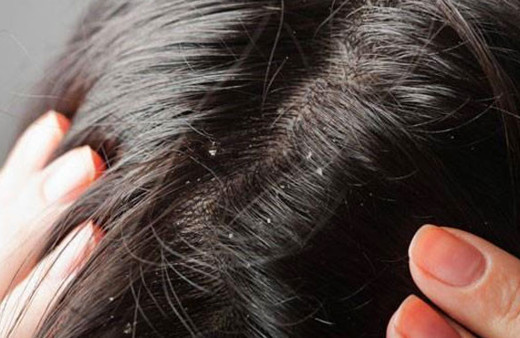 Saçınızdaki kepeklerden kurtulmanın sırları