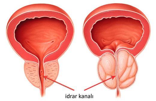 Prostat hastalığı nedir? En önemli belirtileri ve ameliyatı